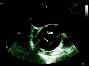 Linear echocardiographic image, short-axis view, suggestive of an intimal flap (arrow). AAo: aortic aneurysm.