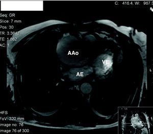 Annulo-aortic ectasia visualized by cardiac magnetic resonance imaging in short- and long-axis view (arrow), respectively, excluding acute aortic dissection. AAo: aortic aneurysm; AE: left atrium; VE: left ventricle.
