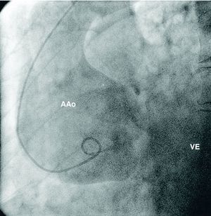 Aortography of the aneurysmal segment, limited to the aortic root and ascending aorta. AAo: aortic aneurysm; VE: left ventricle.