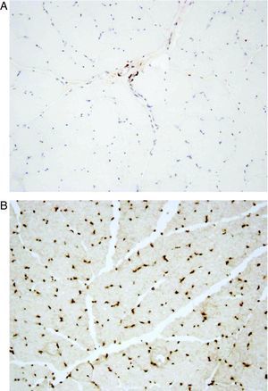 Absence of immunostaining by emerin antibody in all muscle cell nuclei of the index case (A) compared to control (B); 200×.