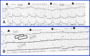 (A) ECG during an episode of chest pain. ST-segment elevation can be observed in the inferior leads. (B) ECG 6min after administration of sublingual nitroglycerine, showing normalization of electrocardiographic alterations.
