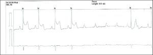 Holter 24-h ECG trace during an episode of chest pain, showing ST-segment elevation and episode of high-degree AVB with ventricular pause of 4.4s.