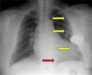 Posteroanterior chest X-ray. The yellow arrows indicate the subcutaneous electrode array and the red arrow indicates the intracavitary electrode.