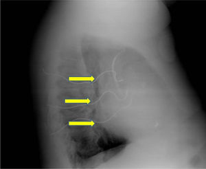 Left lateral chest X-ray. The arrows indicate the subcutaneous electrode array.
