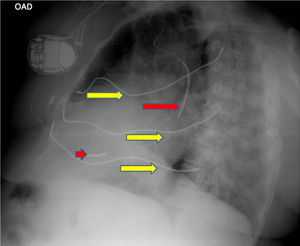 Right lateral chest X-ray. The yellow arrows indicate the subcutaneous electrode array and the red arrows indicate the intracavitary electrode.