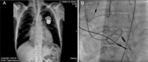(A) Chest X-ray showing two leads crossing the tricuspid valve, one forming a redundant loop; (B) improved visualization of pacemaker leads in left anterior oblique view during right heart catheterization.