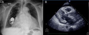 (A) Chest X-ray showing cardiomegaly, obliteration of the costophrenic angles and a redundant loop of the ventricular lead at the level of the tricuspid valve apparatus; (B) B-mode echocardiogram showing moderate pericardial effusion at the left ventricular free wall (1.6cm) and large effusion at the right ventricular wall (2.4–2.1cm).