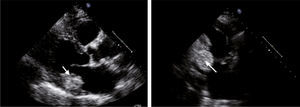 Two-dimensional echocardiogram, parasternal long-axis view (A) and apical two-chamber view (B), revealing an echodense mass at the base of the posterior leaflet.