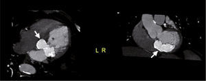 Maximum intensity multislice CT projection showing a partially calcified hyperintense mass (arrow) in non-contrast acquisition (four-chamber and short-axis view).