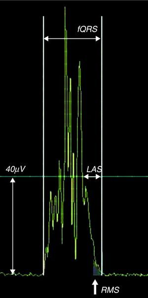 Late potentials are defined by at least two of three criteria: total filtered QRS duration (fQRS) >114ms, the duration of the terminal QRS complex that is less than 40μV (low amplitude signal [LAS]) >38ms, and the voltage in the last 40ms of the QRS (root-mean square [RMS40]) <20μV.