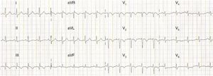 ECG showing sinus tachycardia, S1Q3T3 pattern and T-wave inversion in V1–V4, probably related to ischemia and/or overload in the right ventricle and the ventricular septal region.