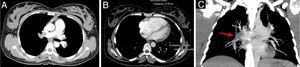 (A) Occlusive thrombus in the right pulmonary artery extending to the lobar branches. An occlusive thrombus can be seen on the left in the superior lobar artery extending to the left pulmonary artery. Another thrombus is visible in the inferior lobar artery, not completely occlusive, extending into the segmental branches; (B) right ventricle measuring 57mm and left ventricle measuring 29mm; (C) coronal plane reconstruction with a thick slice (24mm) in maximum intensity projection, showing thrombus in the right pulmonary artery (red arrow).