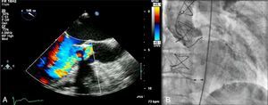 Aortic regurgitation documented by transesophageal echocardiography (A) and aortography (B).