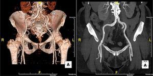 Assessment of vascular access by multidetector computed tomography.