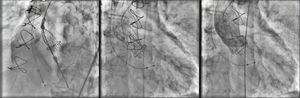 Positioning and release of CoreValve prosthesis.