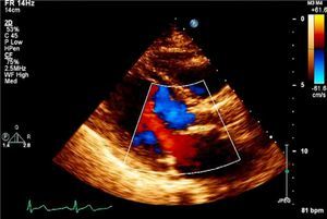 Transthoracic echocardiogram at discharge showing absence of aortic regurgitation.