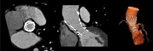 Multidetector computed tomography images showing correct positioning and expansion of the CoreValve six months after implantation.