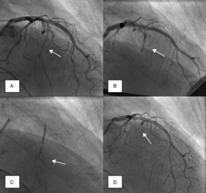 Angiographic demonstration of alcohol septal ablation technique. Left coronary angiography shows the target septal branch (arrow); an angioplasty guidewire is already inserted inside the septal branch (A). Optimal positioning of the balloon catheter (arrow) in the proximal part of the septal artery without compromise of the left anterior descending artery (B). Injection of angiographic contrast dye through the central lumen of the inflated balloon catheter (arrow) determines the supply area of the septal branch and excludes leakage into the left anterior descending artery or other coronary vessels (C). Final demonstration of the septal artery stump (arrow) after alcohol-induced occlusion (D).