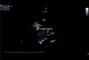 Echocardiogram in parasternal longitudinal view showing thrombus (arrow) and left ventricular posterobasal aneurysm/pseudoaneurysm.