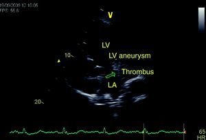 Echocardiogram in 5-chamber view showing thrombus (arrow) and left ventricular posterobasal aneurysm/pseudoaneurysm.