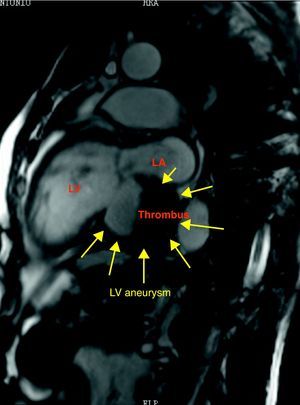 Cardiac magnetic resonance image (steady-state free precession sequence in 2-chamber view) showing a large aneurysm of the left ventricular inferobasal wall with an intracavitary thrombus.