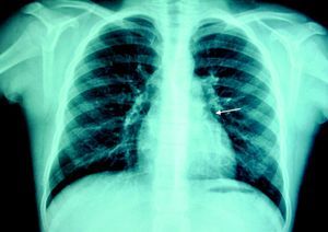 Chest X-ray. A round calcification (arrow) can be observed in the upper left portion of the cardiac silhouette.