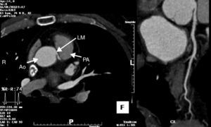 Multiplanar reconstruction. Ao: aorta; PA: pulmonary artery; LM: left main.