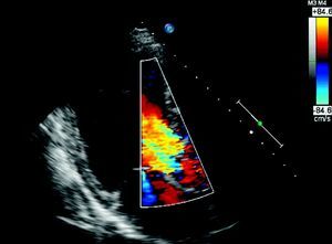 Transthoracic echocardiogram, Doppler mode, parasternal long-axis view, showing severe aortic regurgitation.
