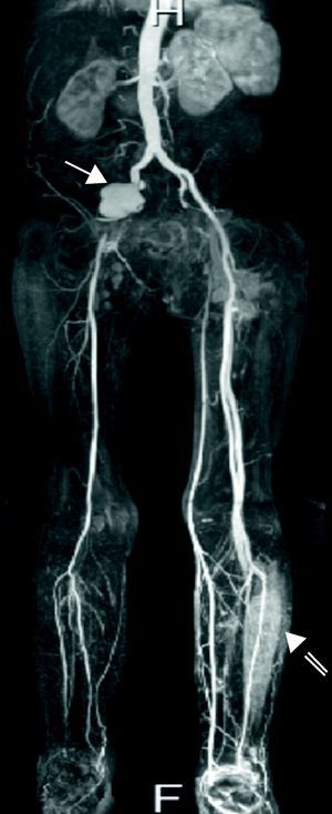 MRI angiogram showing pseudoaneurysm of the right iliac artery (solid arrow) and abscess of the left leg (open arrow).