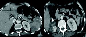 Abdominal CT showing embolus in the celiac trunk (thin arrow), renal infarcts (wide arrow) and splenic infarcts (asterisk).
