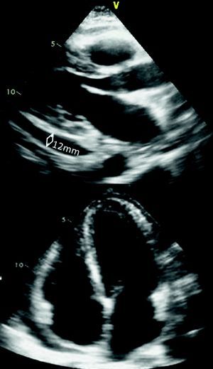 Echocardiogram in parasternal long-axis and apical 4-chamber views showing pericardial thickening with a moderate circumferential effusion.