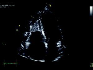 Echocardiogram in apical 4-chamber view showing a mass in the right ventricular apex with the same signal intensity as the myocardium.