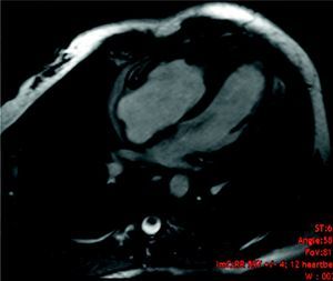 Cardiac magnetic resonance image in apical 4-chamber view showing myocardial thickening in the right ventricular apex of infiltrative appearance.