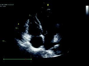 Echocardiogram in apical 4-chamber view showing no alterations.