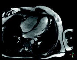 Cardiac magnetic resonance image in apical 4-chamber view showing no alterations.