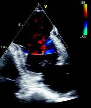 Two-dimensional echocardiogram in diastole, apical 4-chamber view (left) and apical 2-chamber color Doppler (right), showing a wide-necked apical aneurysm with auto-contrast in the left ventricle.