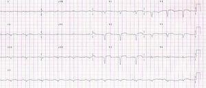12-lead electrocardiogram showing signs of non-recent anterior and inferior myocardial infarction and persistence of ST-segment elevation in V2–V4.