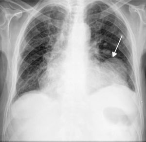 Chest X-ray showing cardiomegaly and a radio-opaque mass next to the left border of the cardiac silhouette (arrow).
