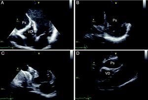 Two-dimensional echocardiogram, in apical 4-chamber (A), short-axis (B), 2-chamber (C) and subcostal (D) views, showing a left ventricular pseudoaneurysm (Ps), with a narrow neck (arrow) extending infero-posteriorly and compressing the right ventricle (VD).