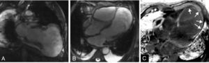 Cardiac magnetic resonance imaging, steady-state free precession sequences in vertical long-axis (A) and 4-chamber (B) views, confirming the presence of a large left ventricular pseudoaneurysm. Delayed enhancement images (phase-sensitive inversion recovery) acquired 10minutes after administration of gadolinium, in 4-chamber view (C), show a transmural area of contrast uptake surrounding the aneurysm (arrows).