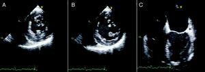 Two-dimensional transesophageal echocardiography, short-axis views in systole (A) and diastole (B) and 4-chamber view in diastole (C), showing a left ventricle of normal dimensions, mildly impaired systolic function and a correctly positioned ventricular patch, with no evidence of leakage.