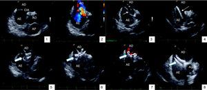 Atrial septal defect closure guided by intracardiac echocardiography: (1) visualization of defect; (2) color Doppler showing left-to-right shunt at the level of the defect; (3) balloon measurement estimating diameter of 19mm; (4) device delivery sheath with guidewire in the left superior pulmonary vein; (5) initial positioning of the device and release of the distal disc in the left atrium; (6) release of the proximal disc in the right atrium; (7) color Doppler showing absence of residual shunt; (8) deployment of device. AE: left atrium; AD: right atrium; AO: aorta; AP: pulmonary artery; CIA: atrial septal defect; VPSE: left superior pulmonary vein. Filled arrow: Amplatzer® device; unfilled arrow: measuring balloon; dashed arrow: device delivery sheath.