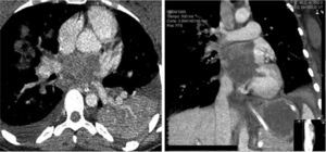 Cardiac computed tomography (CT): CT images showing the tumor occupying almost the entire left atrial chamber and infiltrating the pulmonary veins.