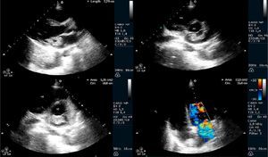 Transthoracic echocardiographic sequence showing a mass measuring 3.1cm adhering to the mitral valve anterior leaflet, causing moderate to severe mitral regurgitation.