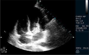 Transthoracic echocardiogram showing the mass adhering to the mitral valve anterior leaflet and protruding into the left ventricle during diastole.