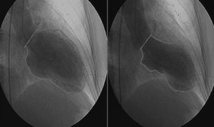 Ventriculography showing akinesia with left ventricular apical ballooning.