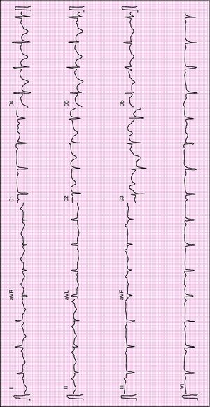ECG with generalized T-wave inversion.