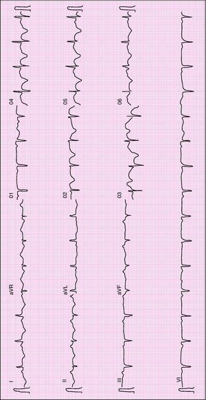 ECG with generalized T-wave inversion.