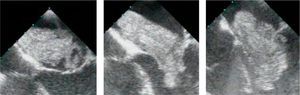 Sequence (left to right) of transesophageal echocardiographic video images showing diastolic motion of a very large villous myxoma, protruding into the left ventricle through the mitral valve, causing structural and functional changes to the valve resulting in mild mitral regurgitation.