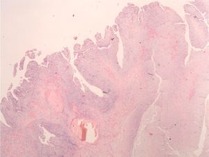 Papillary myxoma (H&E stain).